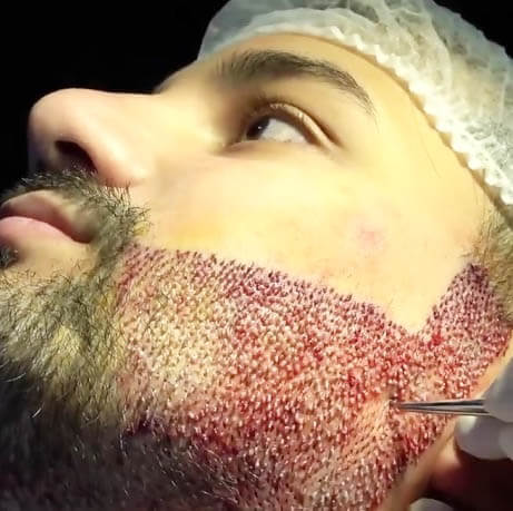 التهاب صورت بعد از عمل کاشت ریش و سبیل-کلینیک کاشت ریش و سبیل اهواز التهاب صورت بعد از عمل کاشت ریش و سبیل-کلینیک کاشت ریش و سبیل اهواز